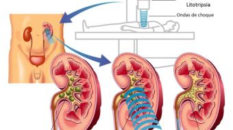 Litotripsia Extracorpórea
