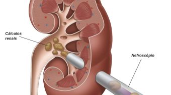 Cirurgia renal percutânea